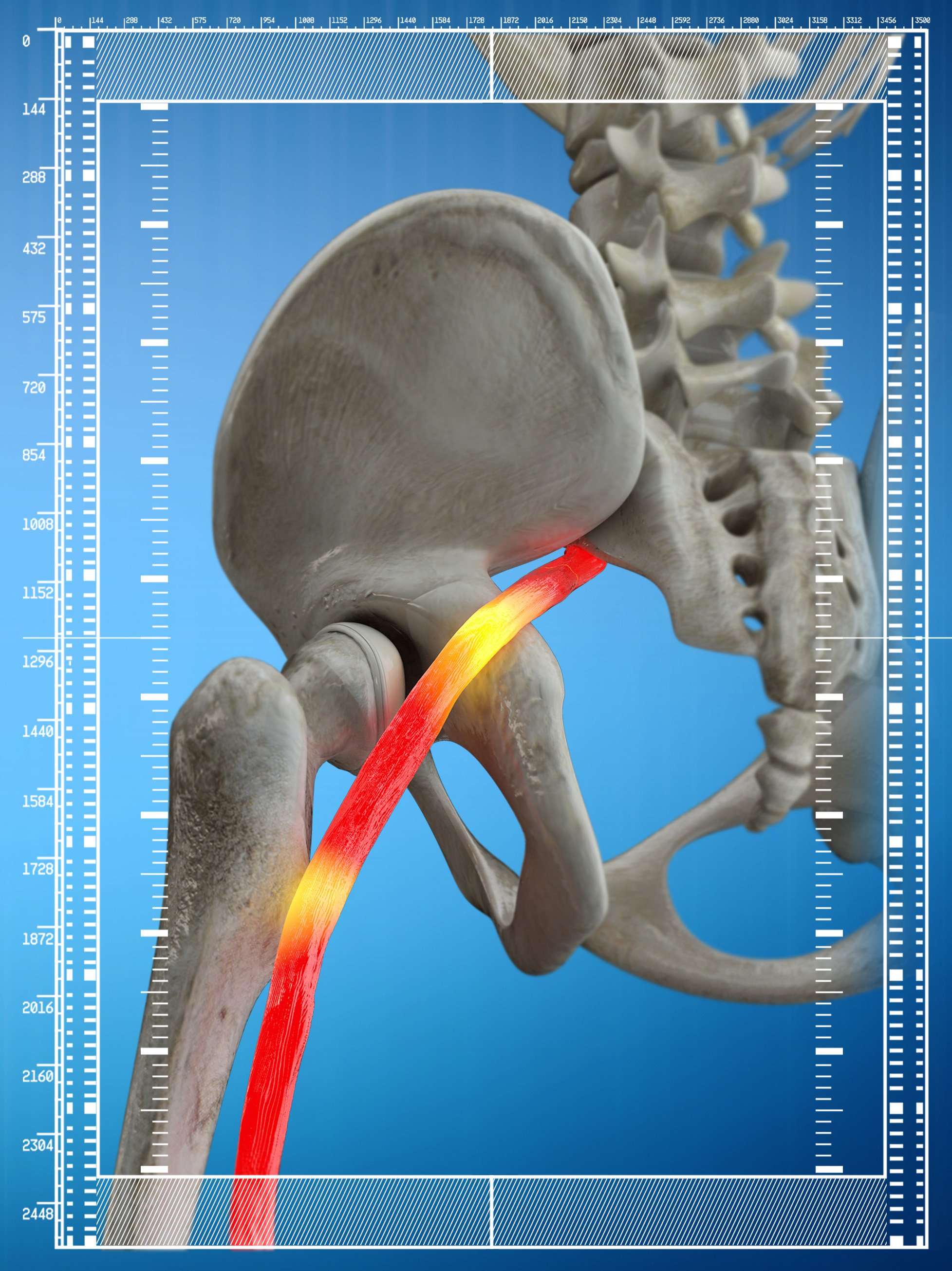 Sciatica illustration